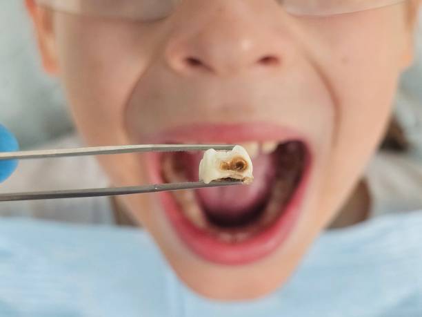Best Emergency Tooth Extraction in Sandy, OR